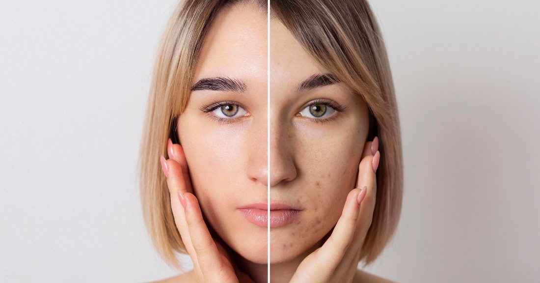 Acne Treatment