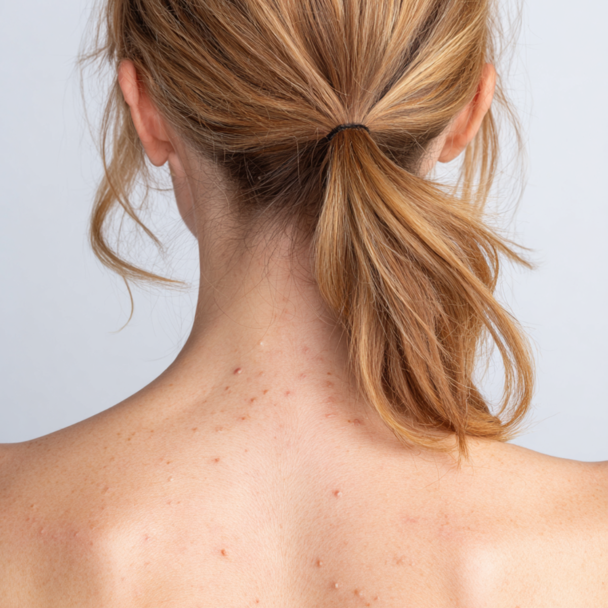 Before using BATHEIA 2% Salicylic Acid Body Wash – visible body acne, rough texture, and strawberry skin.